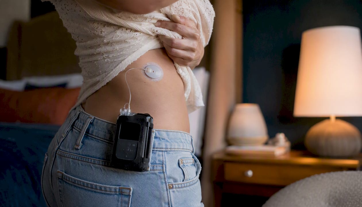 Close-up of insulin pump tubing and CGM sensor on abdomen